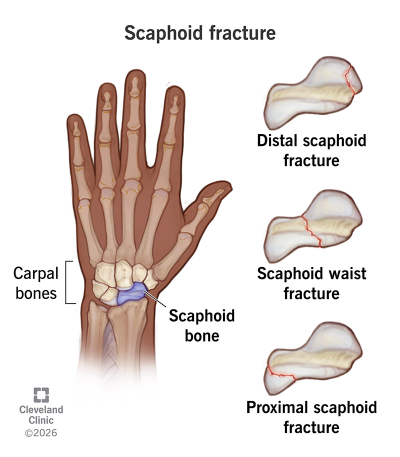 Anatomy of hand and wrist bones, including scaphoid bone, with specific types of scaphoid fractures