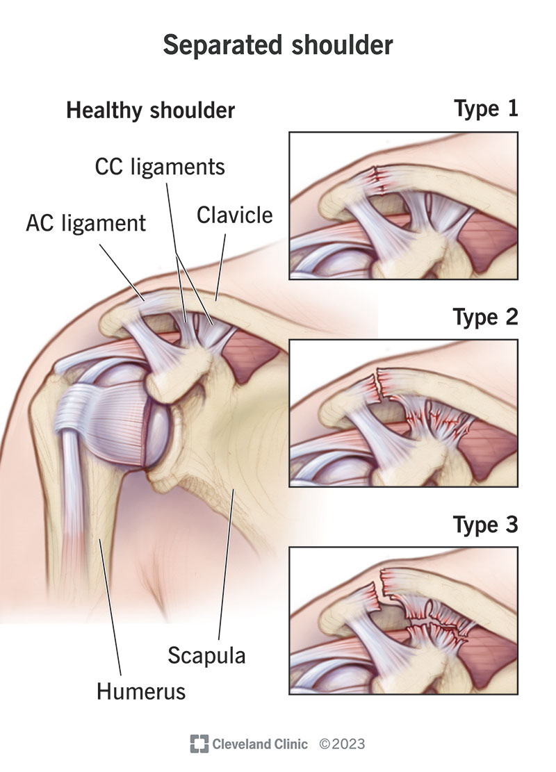 Comparing a healthy shoulder to various types of separated shoulder.