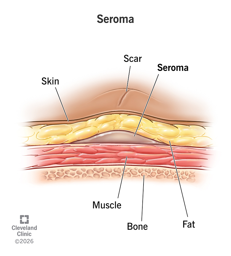 A fluid-filled seroma under scar tissue, between skin, fat, muscle and bone layers