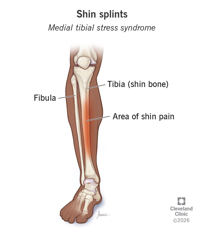 Anatomy of shin splint in a leg, with fibula and tibia bones