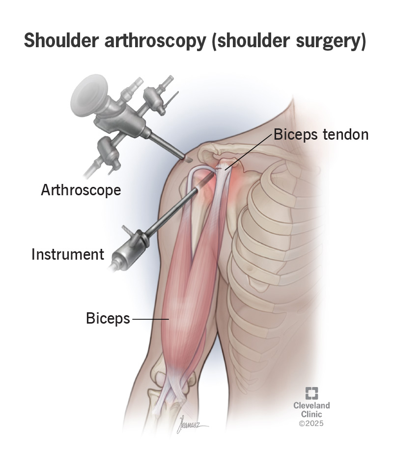 Most shoulder surgeries are minimally invasive arthroscopies
