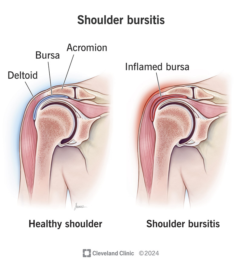 Shoulder bursitis happens when something damages or irritates a bursa in your shoulder.