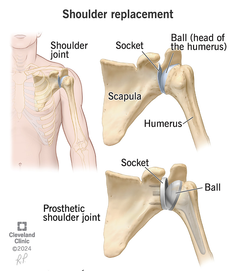 A surgeon will replace the bones and connective tissue in your shoulder joint with a prosthesis