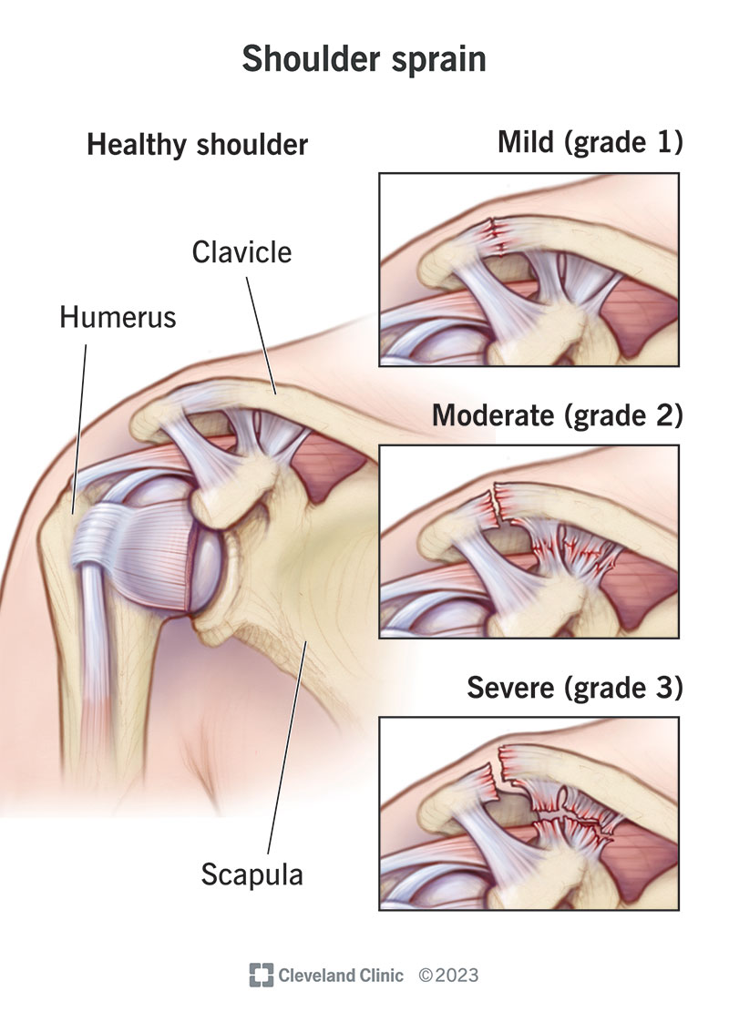 Shoulder sprain: mild, moderate and severe; with healthy shoulder