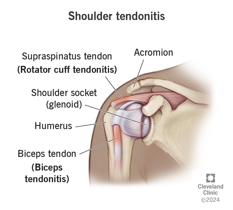 Shoulder tendonitis (tendinitis) can affect your rotator cuff tendons or your biceps tendon.