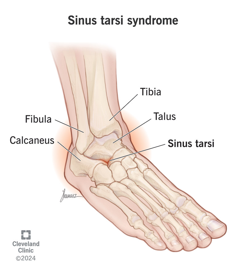 Sinus tarsi syndrome is painful swelling where your ankle bone (talus) meets your heel bone (calcaneus)