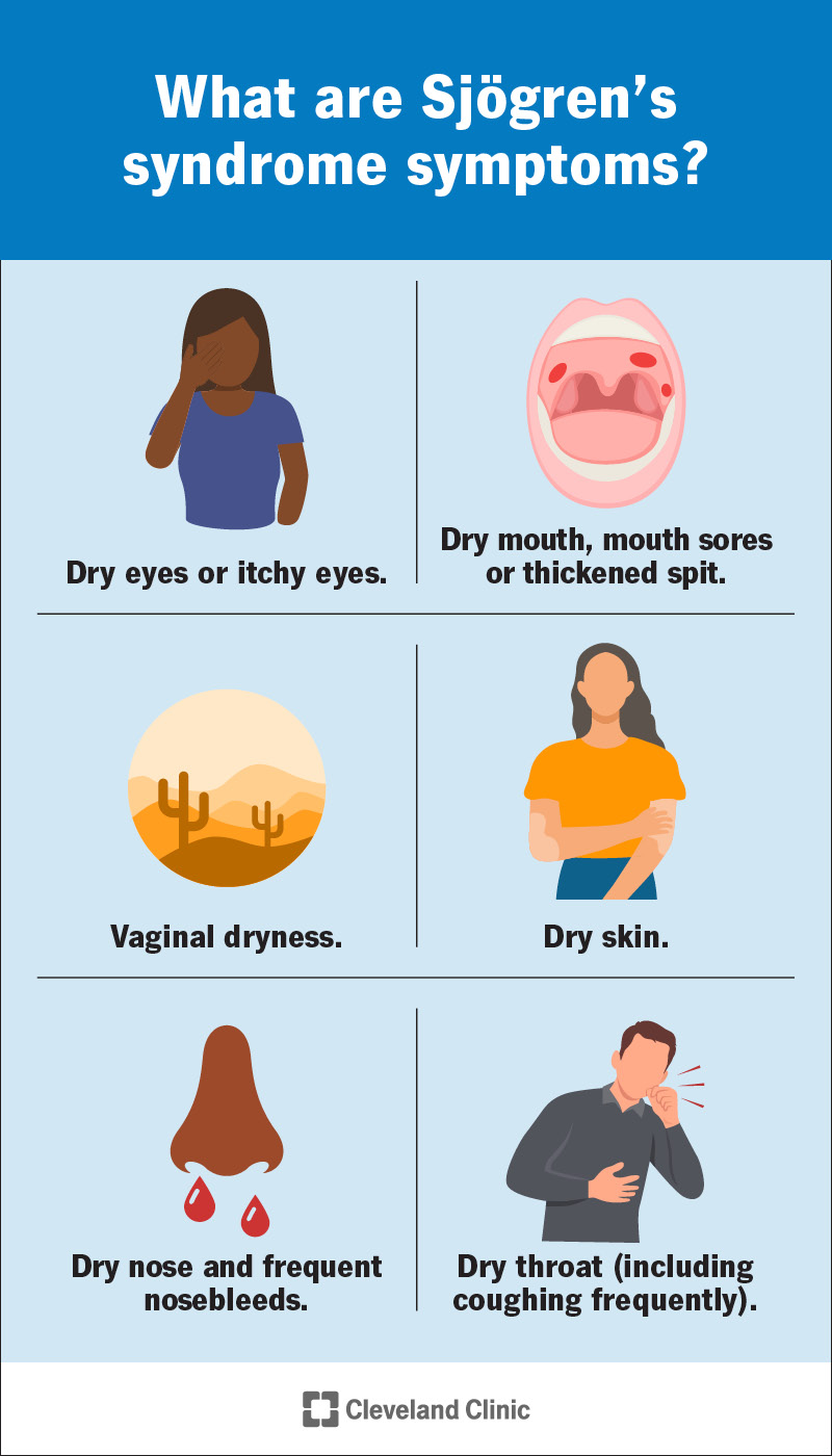 Sjögren's Syndrome: Symptoms & Treatment