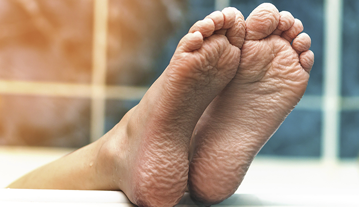 Bottoms of feet with macerated skin, which looks soft, wrinkly and light-colored