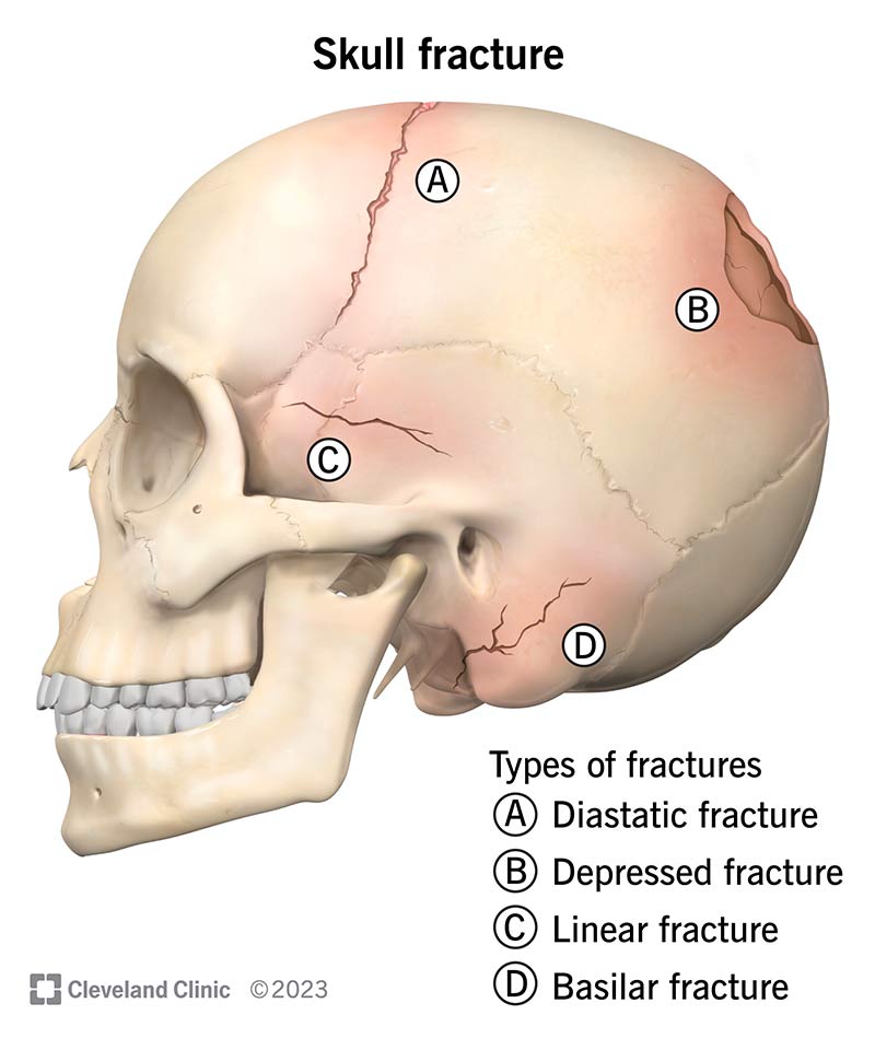 Four types of skull fractures on a human.