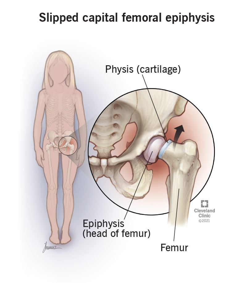 The head of the femur bone is slipping off of the neck (slipped capital femoral epiphysis)