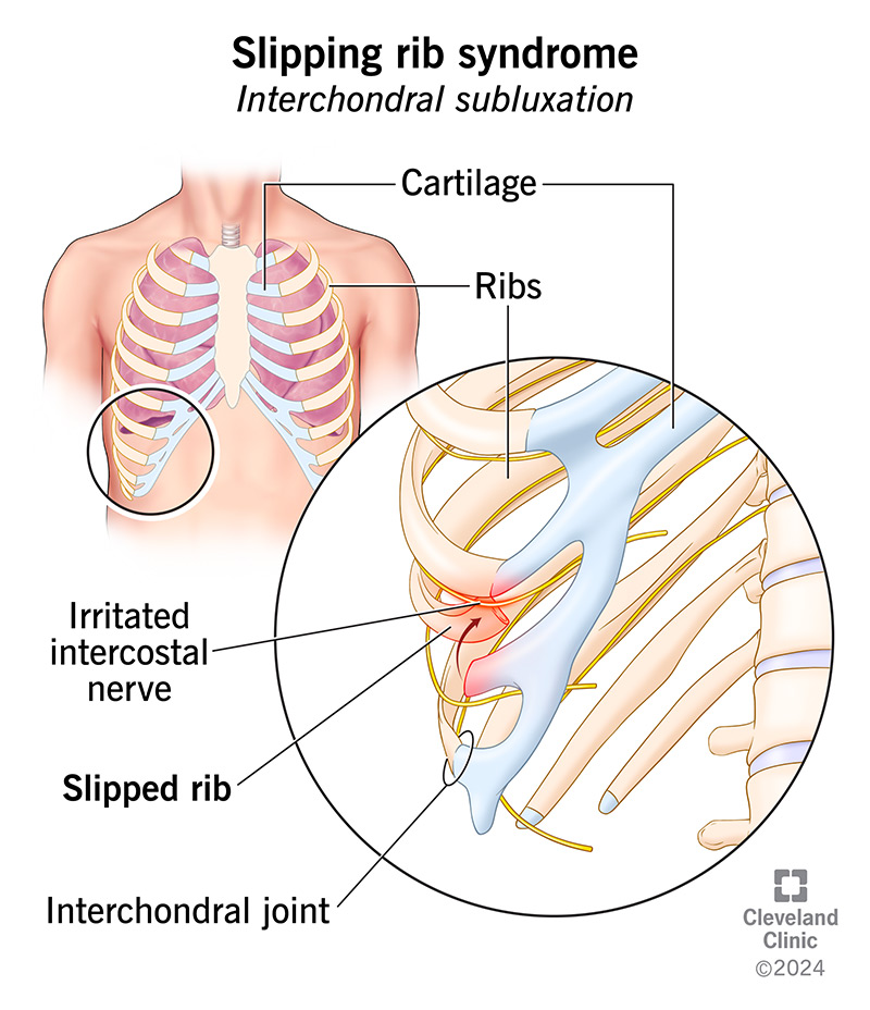 Slipping rib syndrome causes pain when one of your ribs slips out of place and irritates a nerve