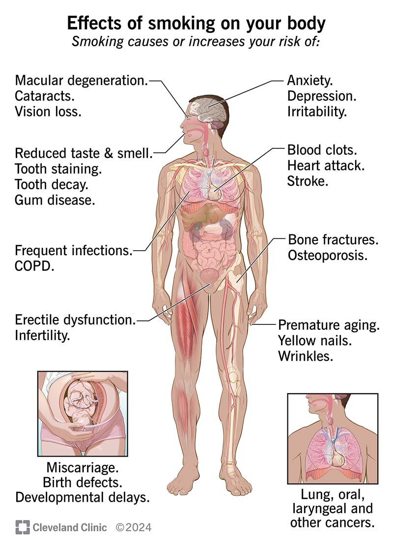 Effects of smoking on your body, including: skin, nails, eyes, nose, mouth, lungs, heart, blood vessels, brain, and bones.