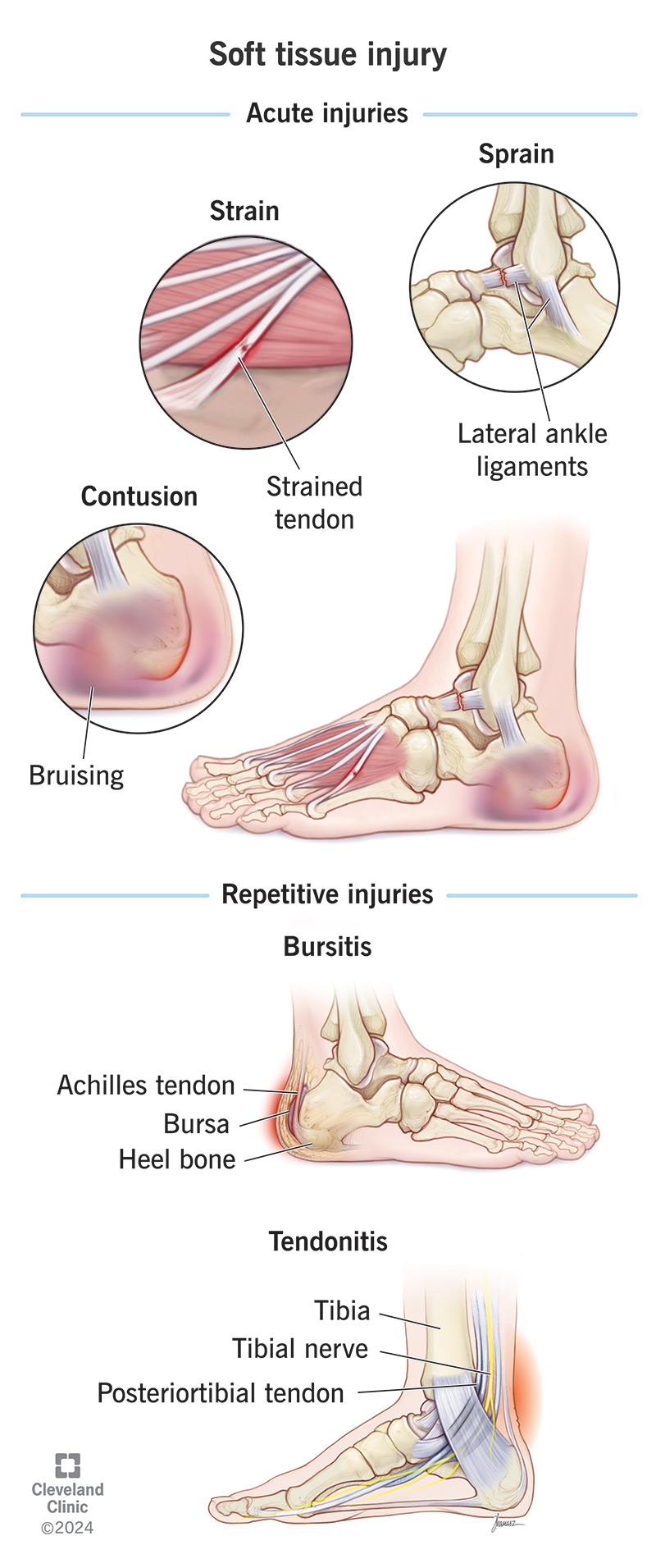 Illustration of common soft tissue injuries.