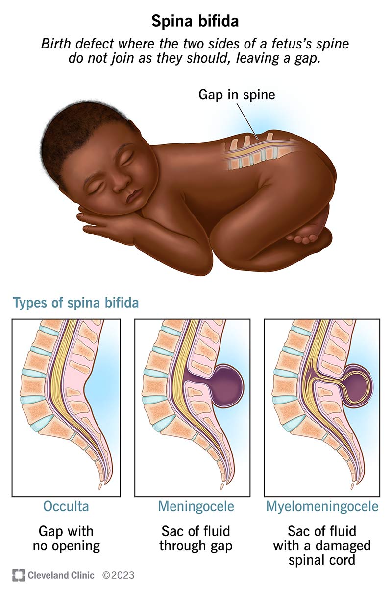 Spina Bifida What It Is Causes Symptoms Treatment