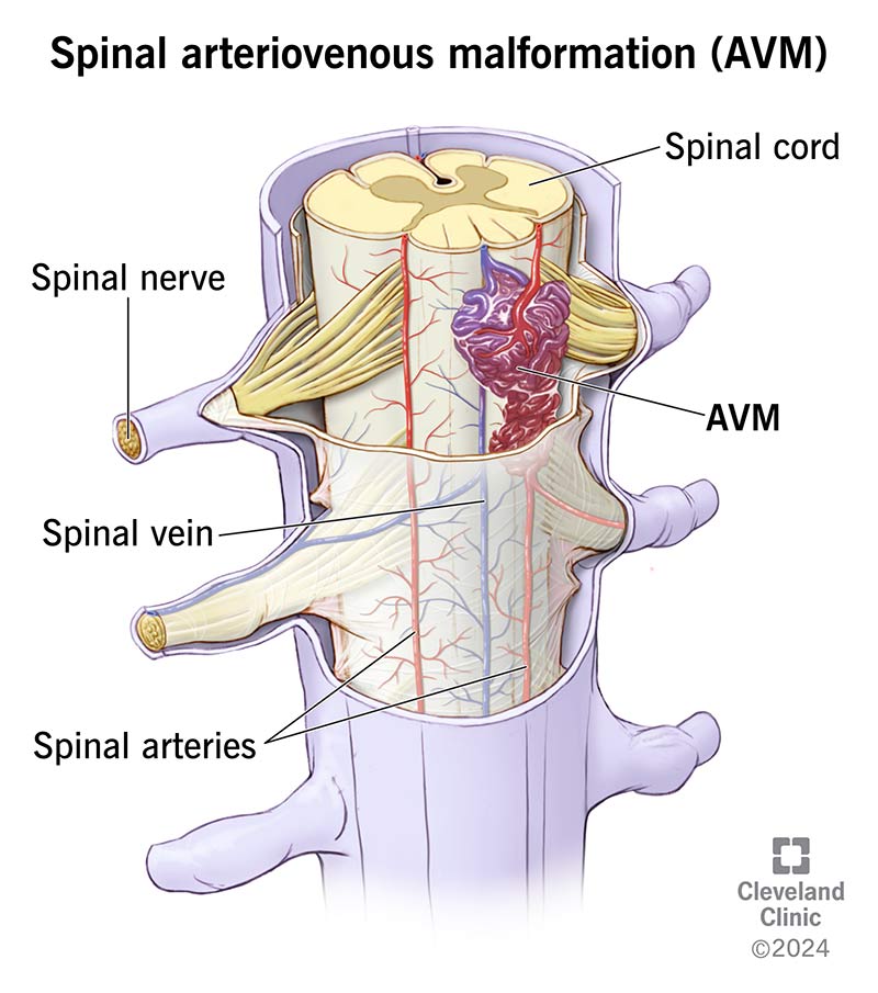 Spinal AVM: What It Is, Symptoms, Treatment & Prognosis