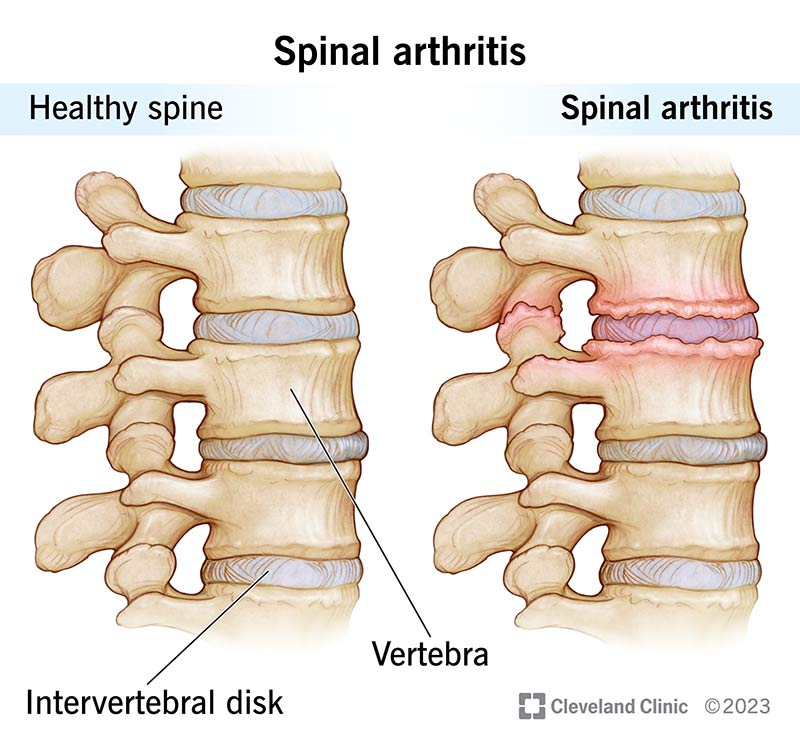 Spinal arthritis is inflammation in your spine where your vertebrae meet.