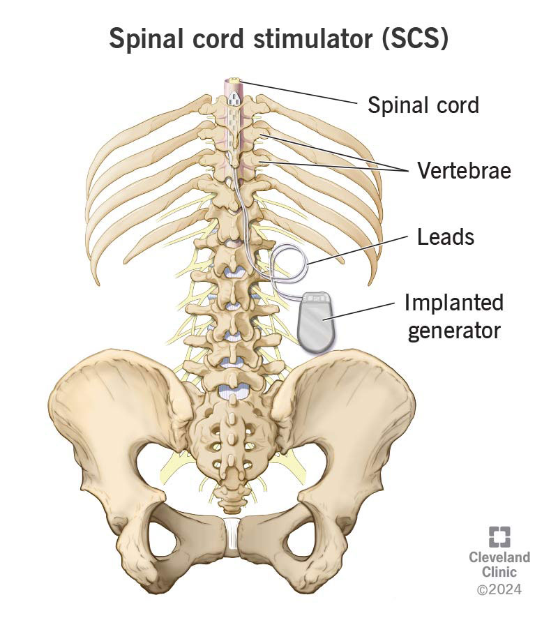 A spinal cord stimulator is a device a surgeon implants in your body to help you control chronic pain.