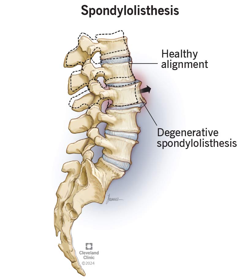 Spondylolisthesis makes one of your vertebrae slide out of its usual spot onto the one below it