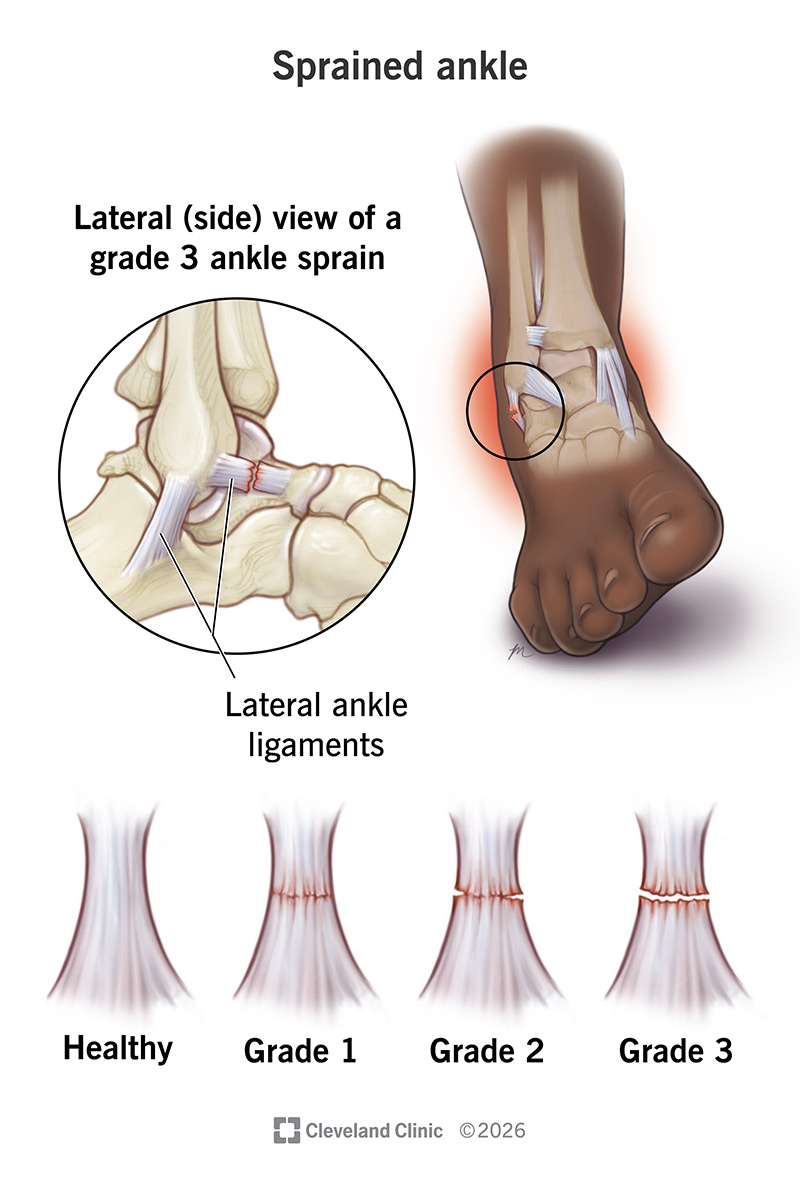 Grade 3 ankle sprain showing complete ligament tear