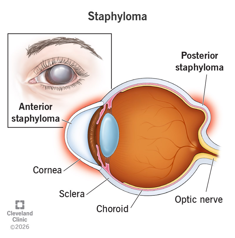 Antomy of an eye with the two types of staphyloma, with bulging (outpouching) in front (anterior) and back (posterior)