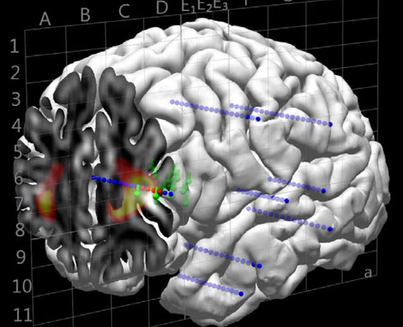 3D brain with implanted electrodes and colored signals showing recorded electrical activity