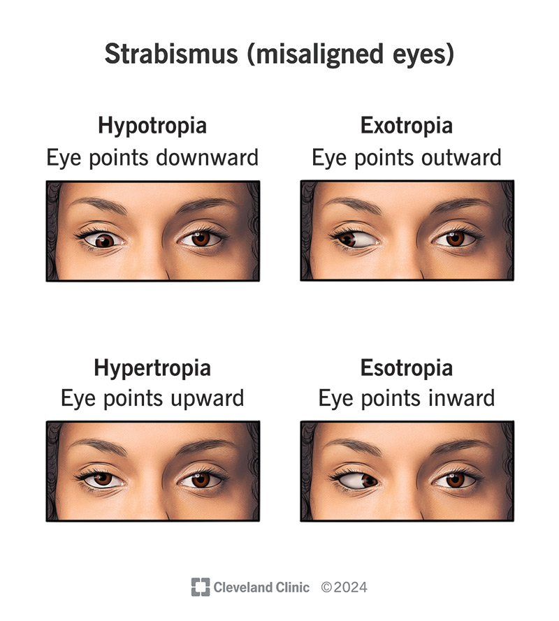 With strabismus, your eye can point up (hypertropia), down (hypotropia), in (esotropia) or out (exotropia)