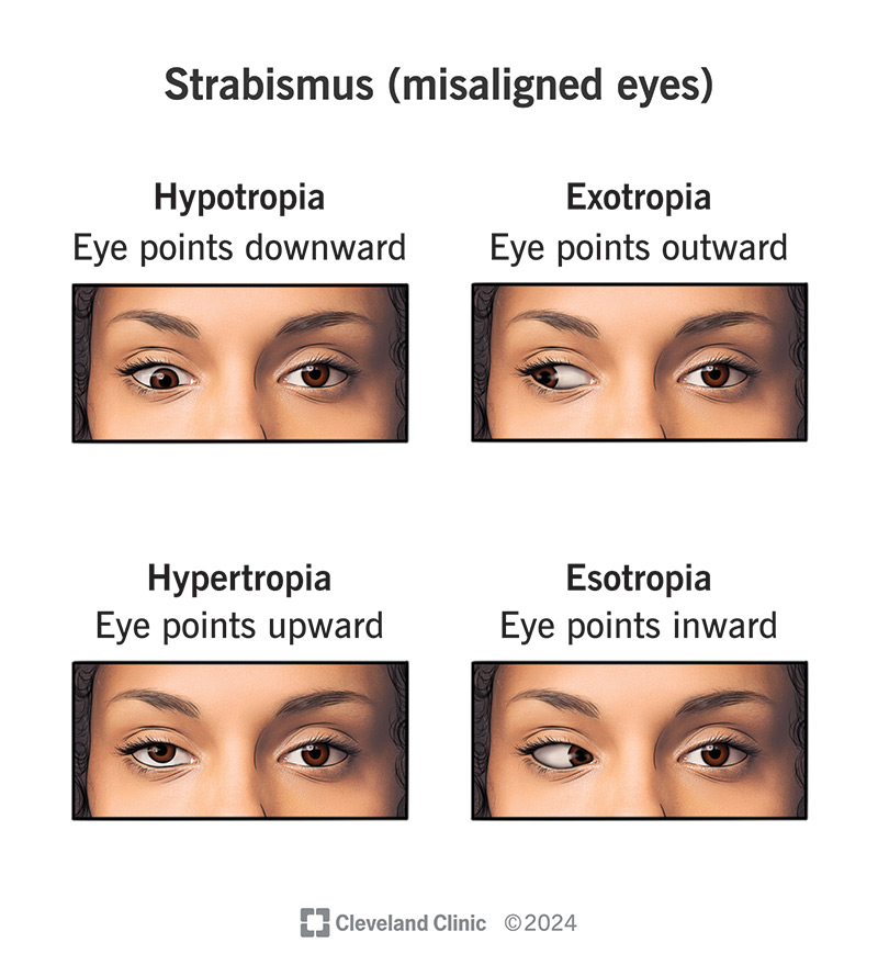 Strabismus  A Patient Guide to Misalignments of the Eyes 