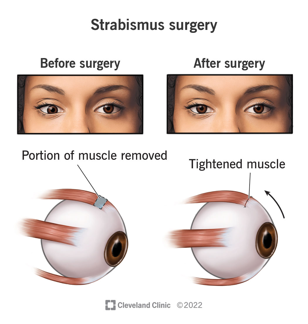 Eye muscles and eye alignment before and after strabismus surgery