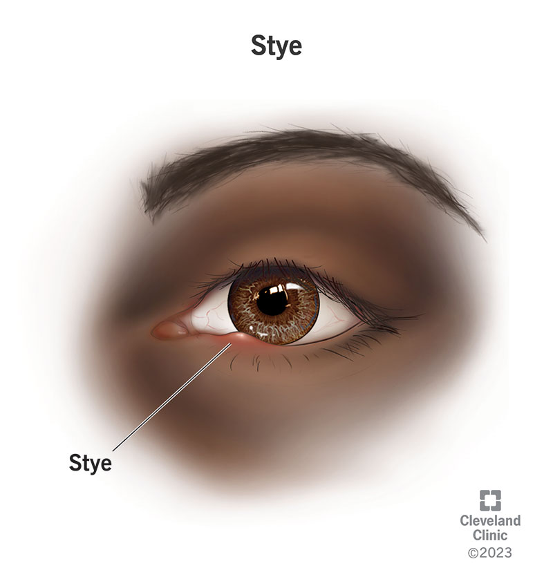 A stye forming on the edge of a person’s lower eyelid.