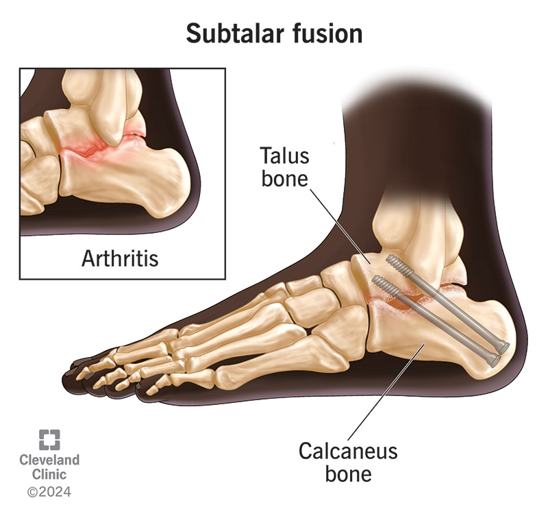 Surgeons most commonly use subtalar fusion to treat severe foot arthritis.