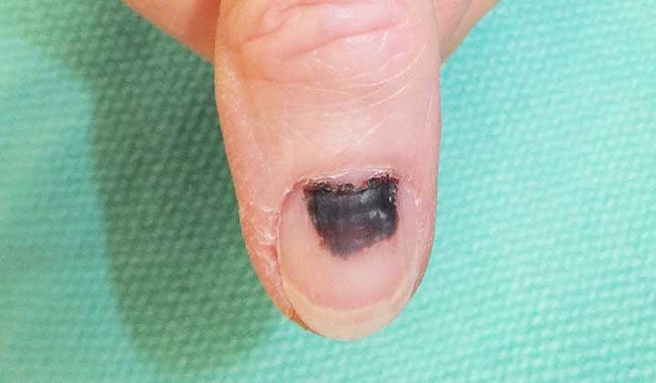 Subungual melanoma underneath a person’s fingernail.