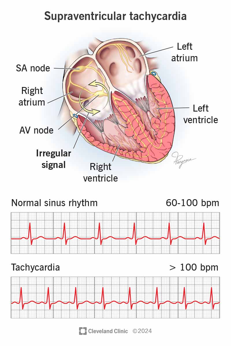 SVT is an abnormal heart rhythm that’s very fast and starts in the upper part of your heart