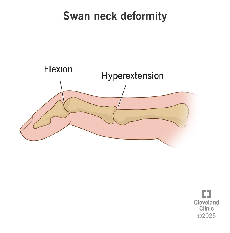 Swan neck deformity makes your finger bend in the shape of a swan's neck.