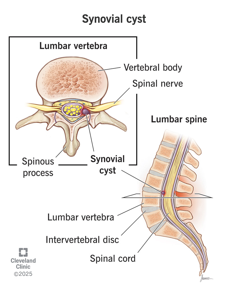 A synovial cyst is a fluid-filled sac that forms between facet joints in your spine