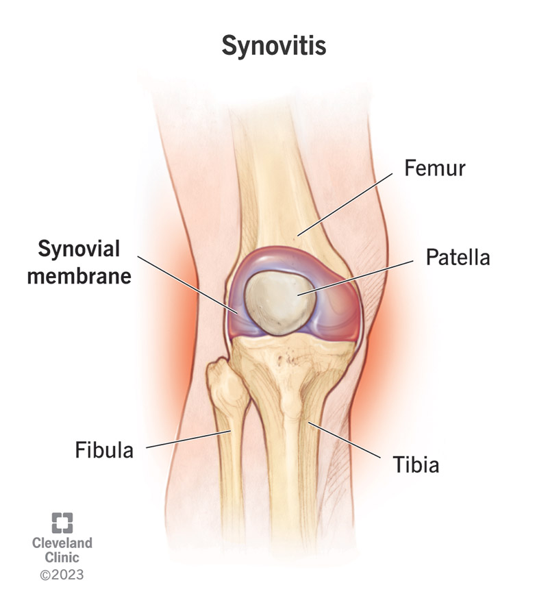 An illustration of a knee joint experiencing synovitis.
