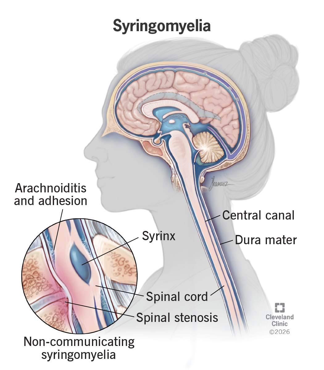 Cross-section of brain and spinal cord, with syrinx cavity for non-communicating syringomyelia