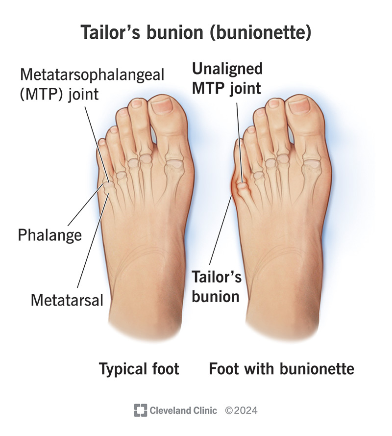 A tailor’s bunion is a bony bump that forms at the base of your pinkie toe where it meets your foot.