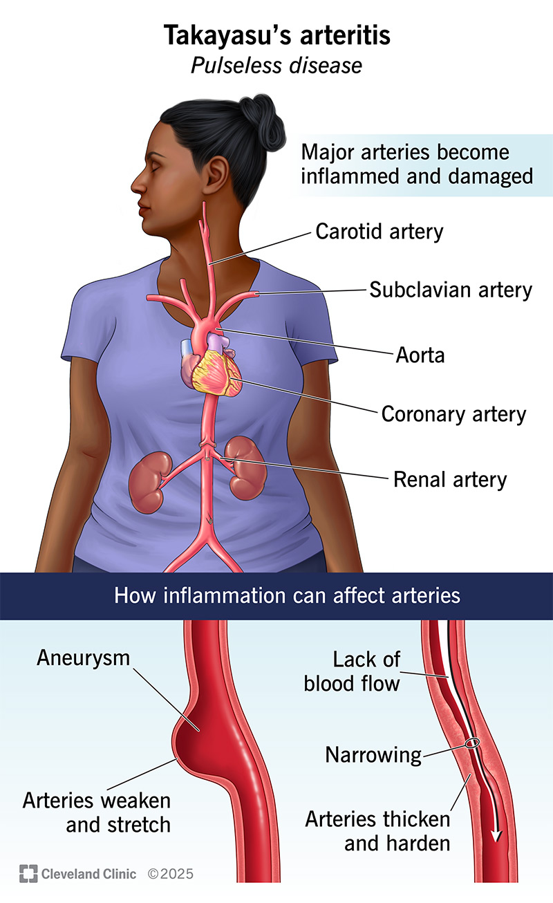Takayasu arteritis damages the major arteries throughout your body.