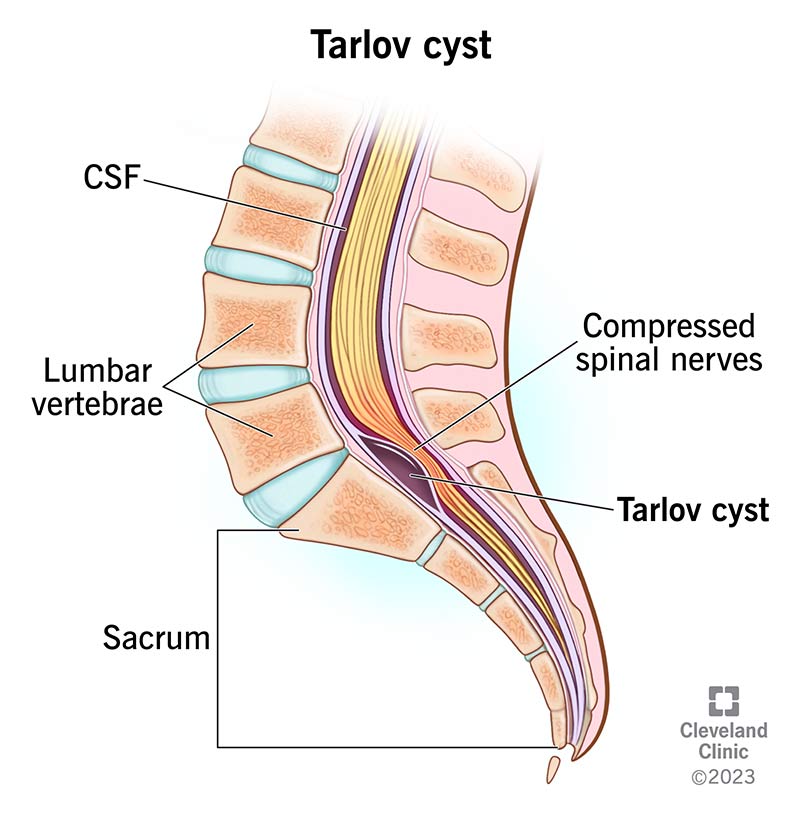 A Tarlov cyst sitting near the base of a human spine, with compressed spinal nerves