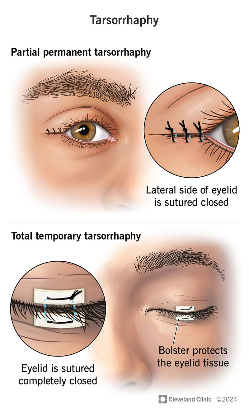 Tarsorrhaphy holds one or both eyelids closed either partially or totally, protecting your eye surface.