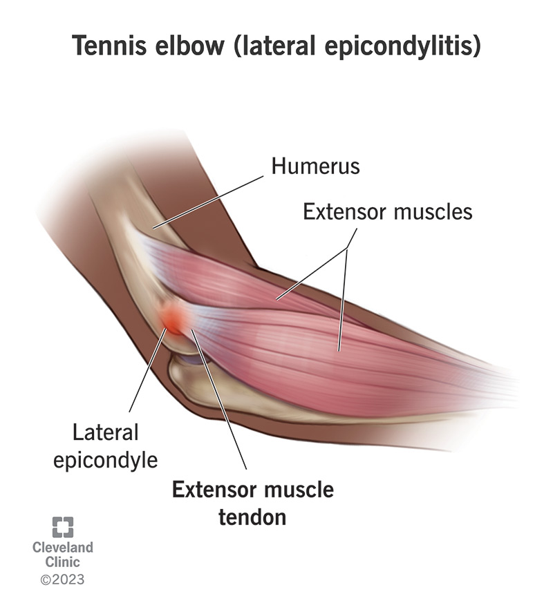 Tennis elbow (lateral epicondylitis) is painful inflammation in your elbow.