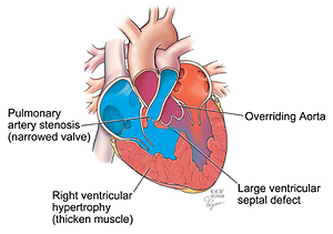 Tetralogy of Fallot in Adults | Cleveland Clinic: Health Library