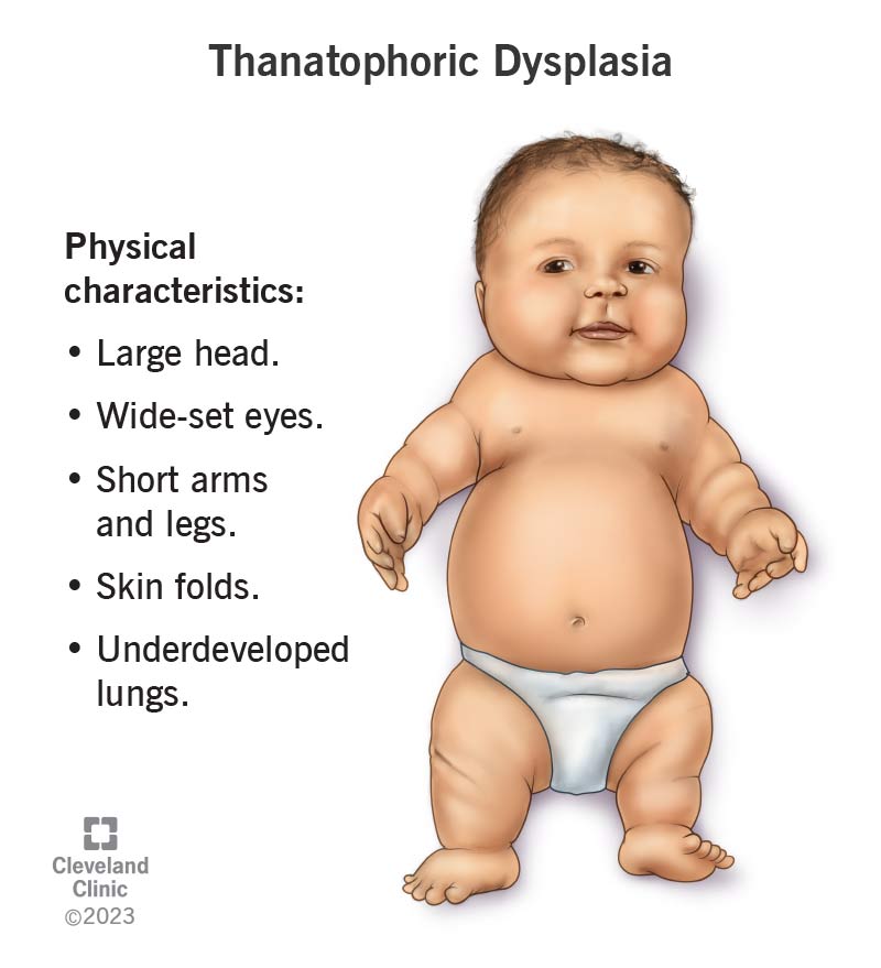 Thanatophoric dysplasia physical characteristics in a baby