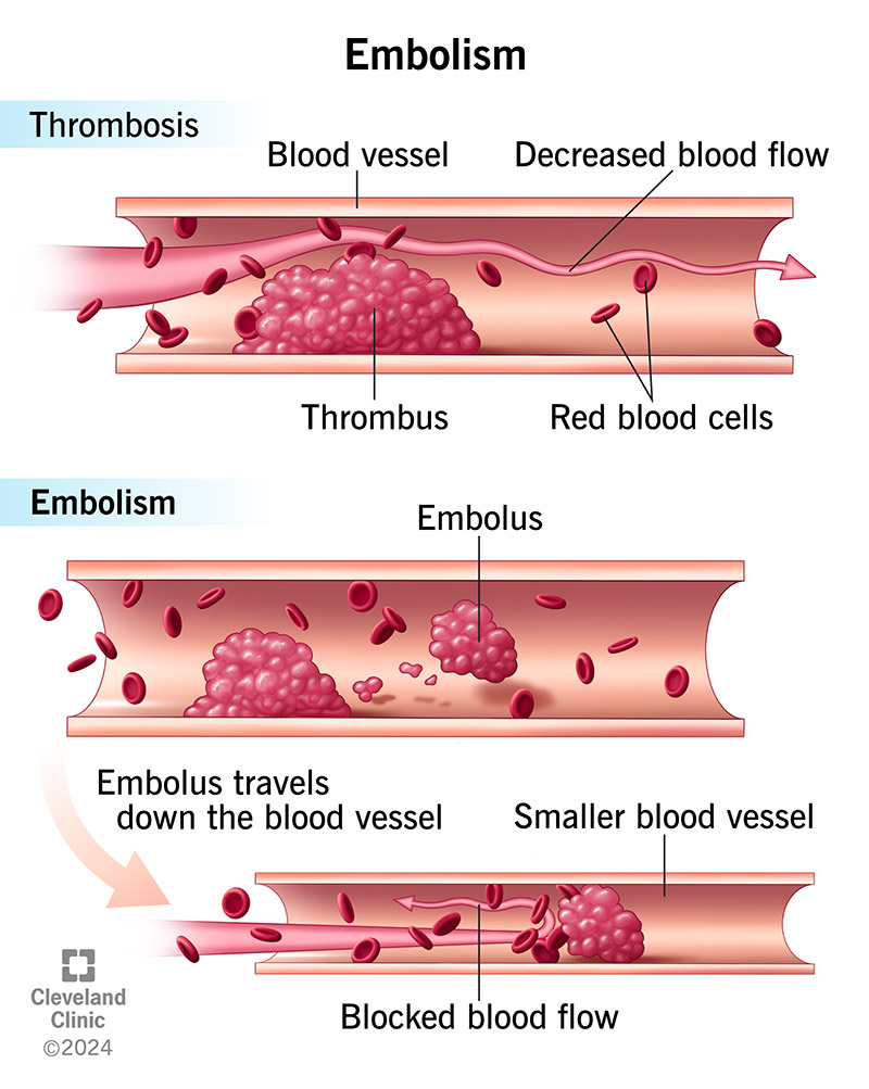 A blood clot can move to another blood vessel and create an embolism or blockage.
