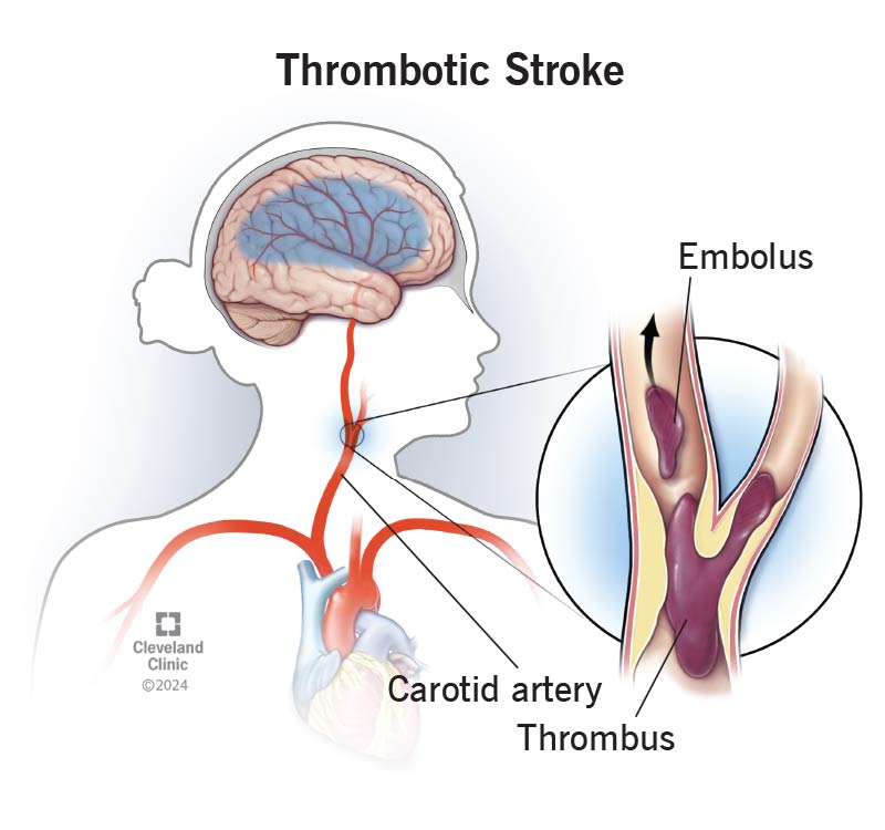 A brain in a human head, with thrombotic stroke, with a blood clot in the carotid artery