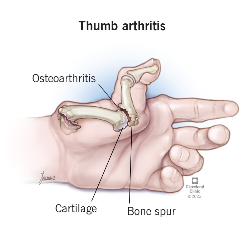 Thumb arthritis, osteoarthritis, developing in a person’s thumb joint