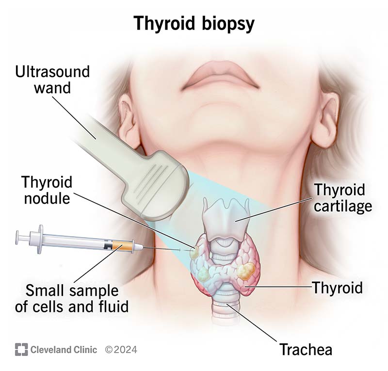 A thyroid in a person’s neck with an ultrasound wand and a fine-needle syringe taking cell samples