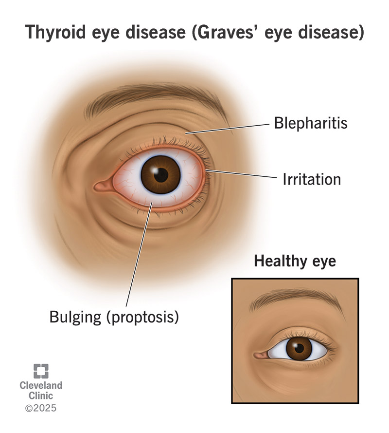 Thyroid eye disease causes irritation and swelling around your eye, which can make it bulge