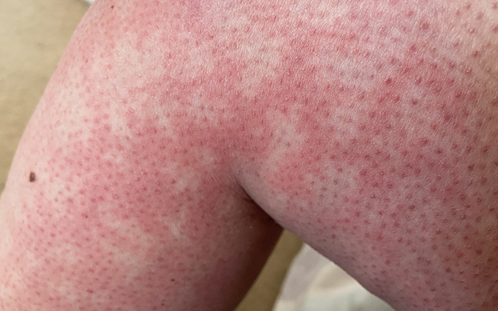 Skin rash from toasted skin syndrome