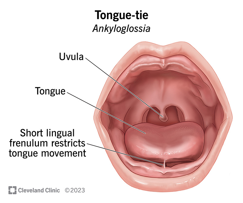 In babies with tongue-tie, a short lingual frenulum restricts tongue movement.